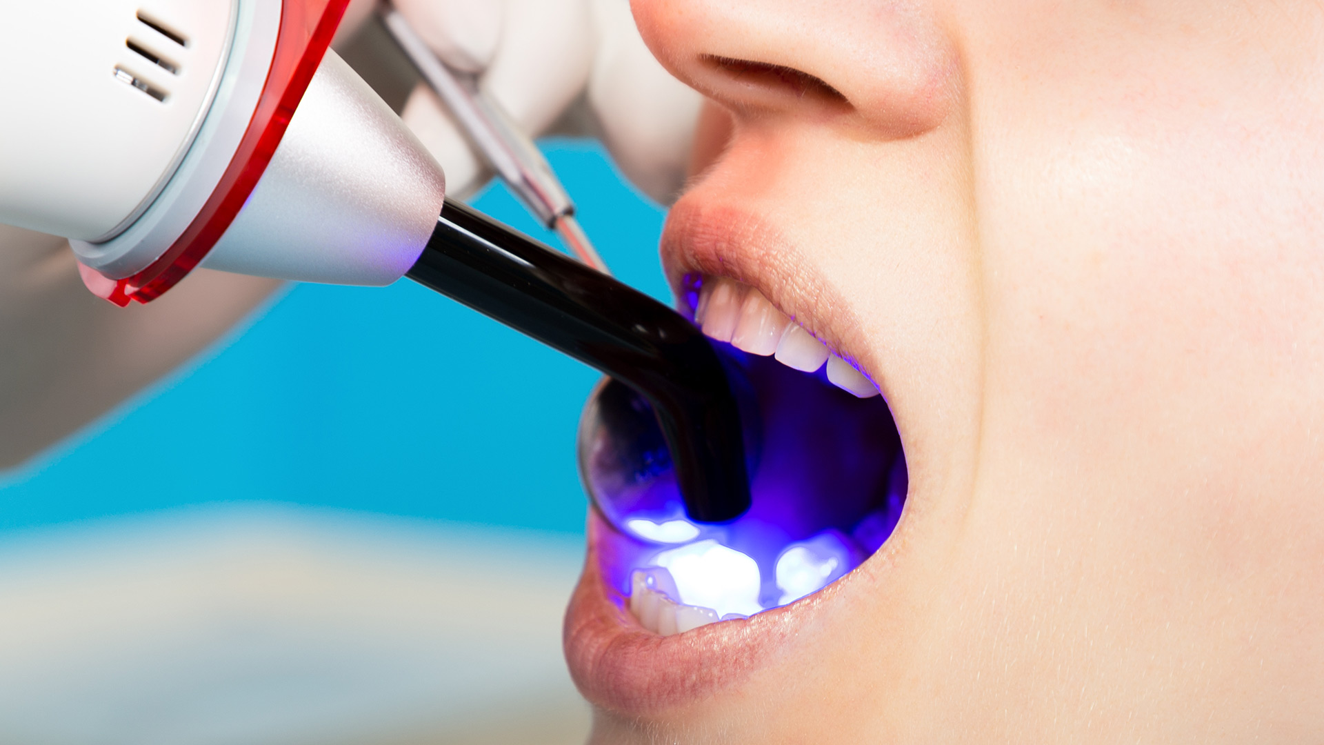 Professional Teeth Bonding Services in Greenville